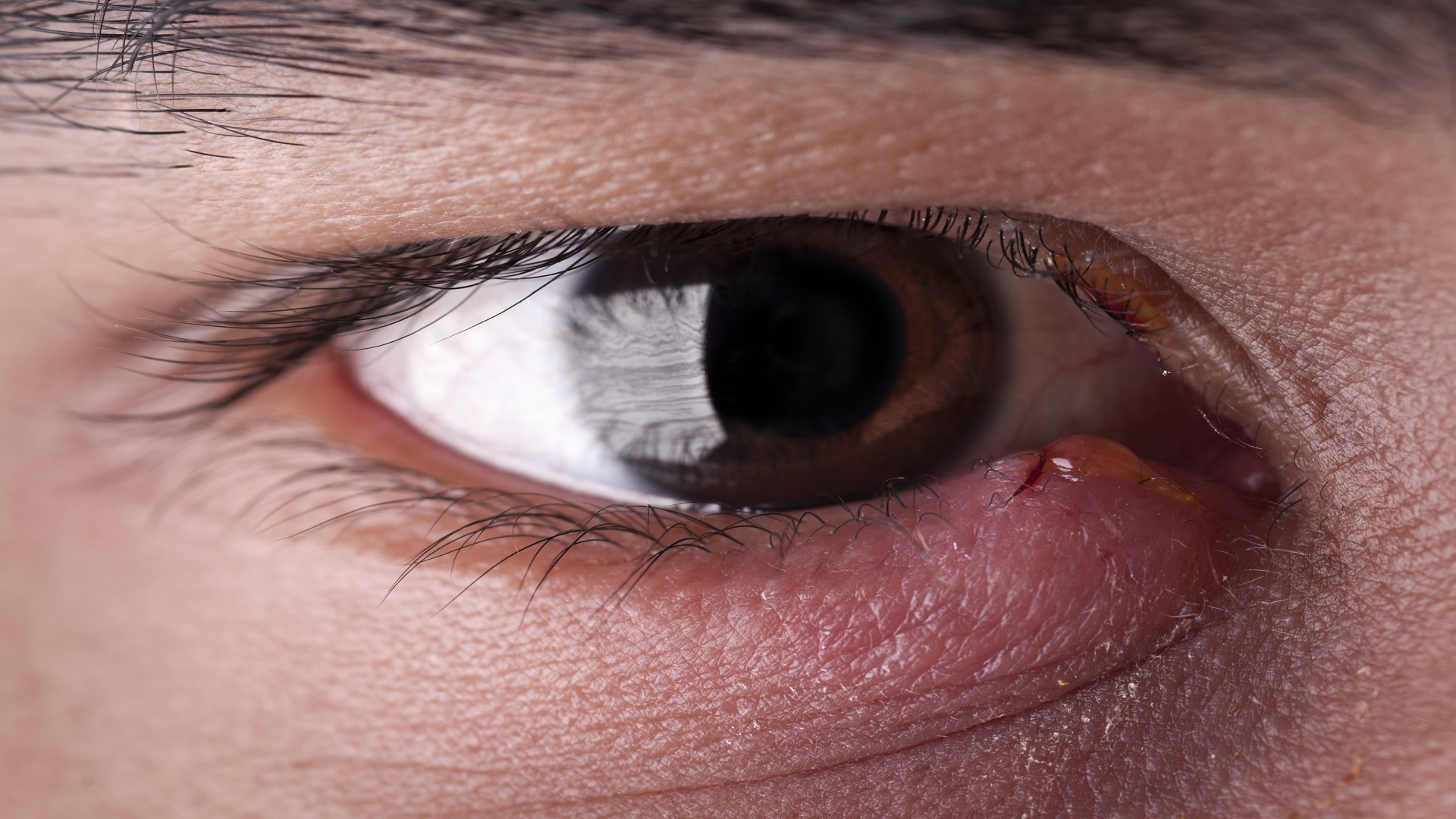 أعراض وأسباب ومضاعفات دمل العين الجاف