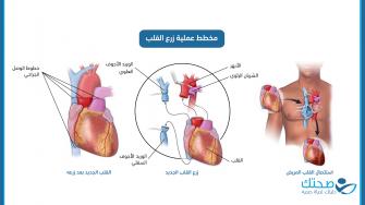 مخطط عملية زرع القلب