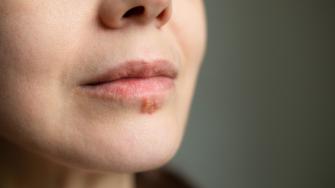 التهاب الجلد حول الفم