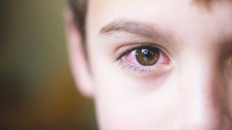ما الفرق بين احمرار العين والحساسية؟