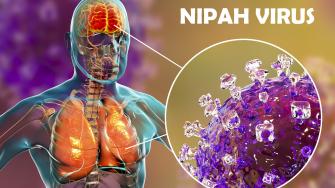 فيروس نيباه: الأعراض والأسباب والتشخيص والعلاج والوقاية