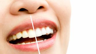 أفضل العلاجات المنزلية للتخلص من اصفرار الأسنان