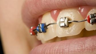 دعامات تقويم الأسنان المعدنية والسيراميكية.. أيهما تختار؟