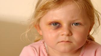 حوادث العيون عند الأطفال.. كيف تتصرف؟