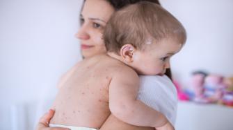 ما سبب الحساسية الجلدية في الرضع؟