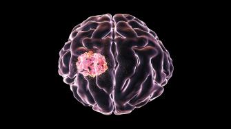 أعراض وأسباب أورام الدماغ في الأطفال