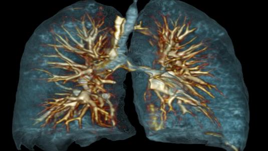 ما الفحوصات المطلوبة لتشخيص سرطان الرئة؟