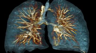 ما الفحوصات المطلوبة لتشخيص سرطان الرئة؟