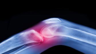 هل يسبب فرط تمديد الركبة إصابة خطيرة؟