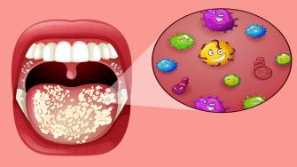 علاج فطريات الفم في الأطفال والكبار