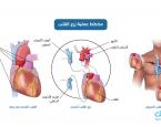 مخطط عملية زرع القلب