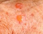 علامات احتمال الإصابة بسرطان الجلد