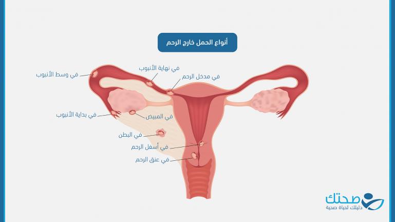 أنواع الحمل خارج الرحم