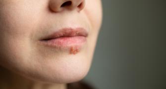 التهاب الجلد حول الفم