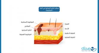 سرطان الخلايا الصباغية في الجلد