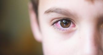 ما الفرق بين احمرار العين والحساسية؟