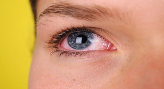 7 مشاكل شائعة للعين.. علاجات منزلية