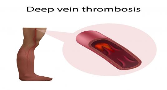 Deep venous thrombosis