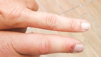 ما هي أسباب تورم أصابع اليدين؟