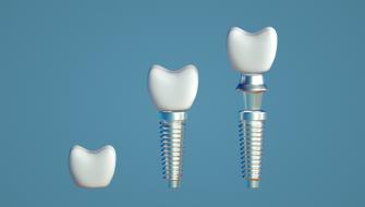 مقارنة بين أطقم الأسنان وزرعات الأسنان: ما هو الأفضل لك؟
