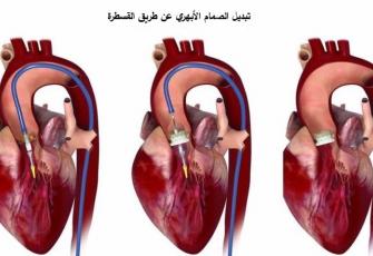 عملية تبديل الصمام الأبهري في القلب عن طريق القسطرة