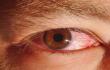 التهاب الملتحمة أو العين القرنفلية (ملف)