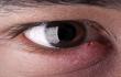 أعراض وأسباب ومضاعفات دمل العين الجاف
